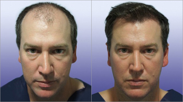 Hair Regrowth and Transplant Clinic in South Delhi